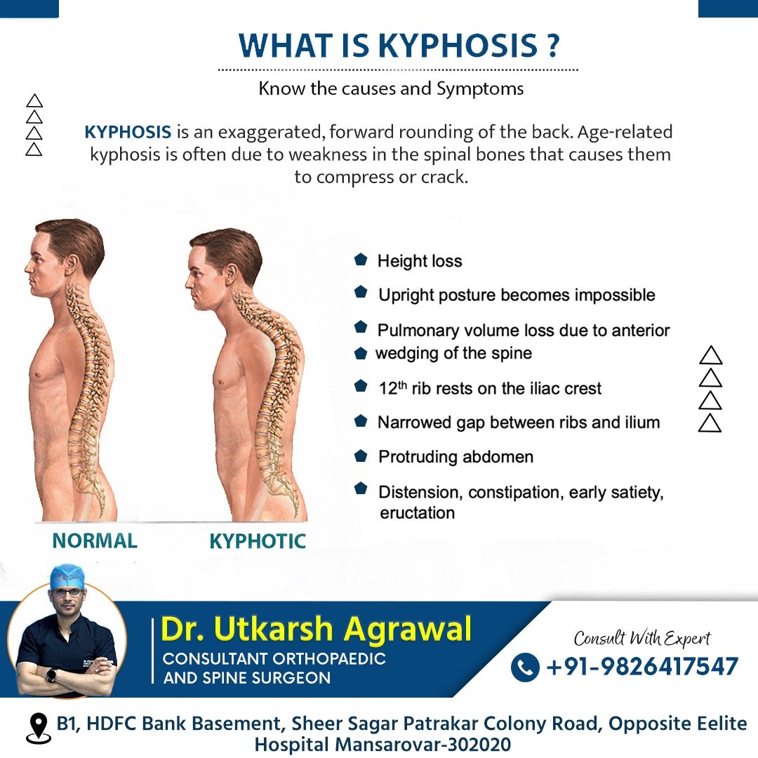 What is Kyphosis? Causes, Symptoms, and When to Consult a Spine Specialist