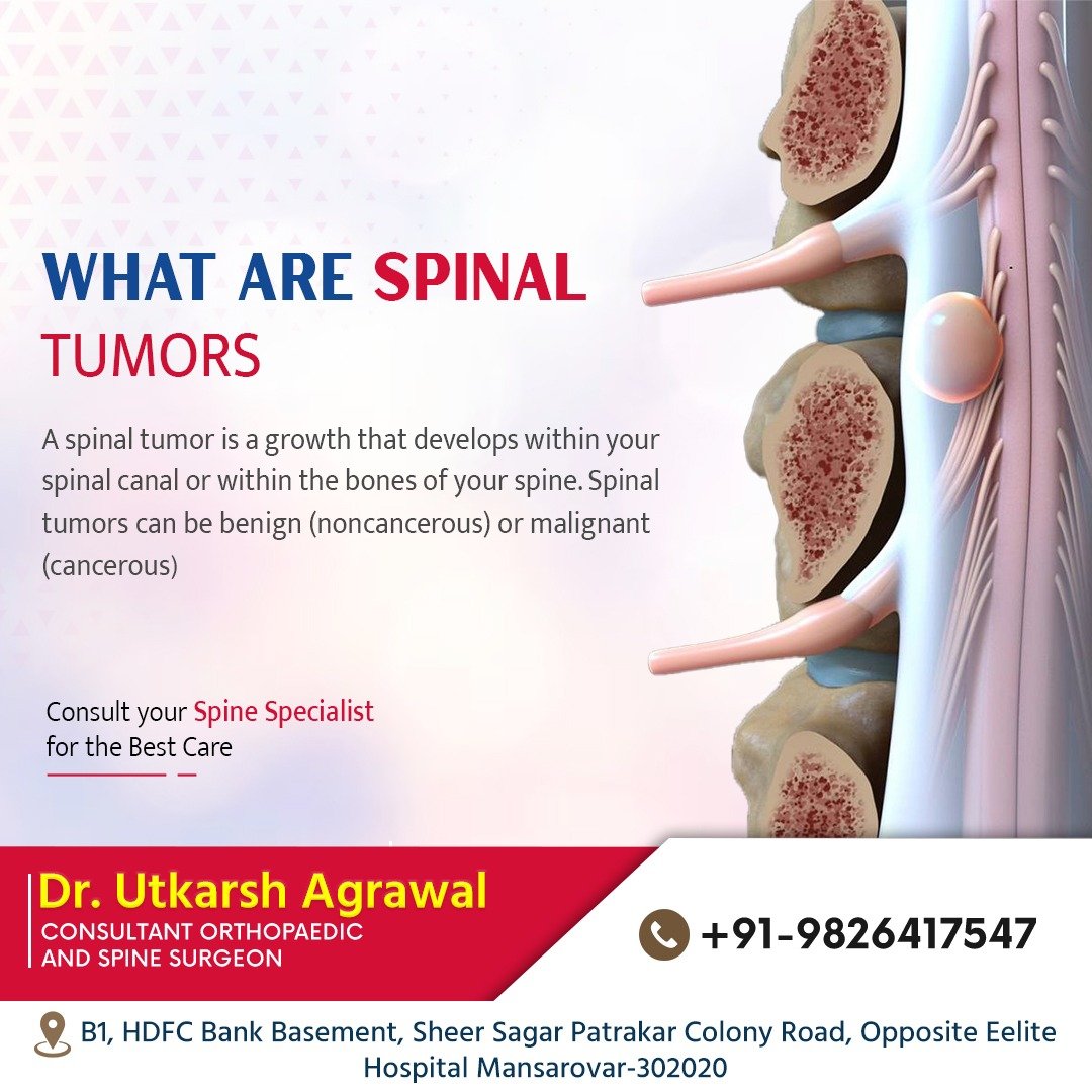 What Are Spinal Tumors