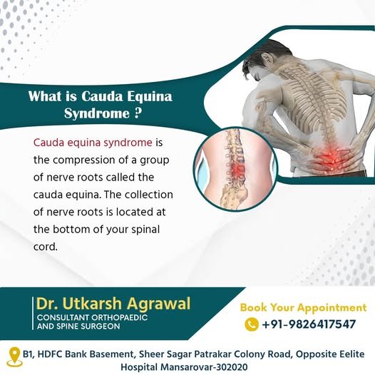 What is Cauda Equina Syndrome